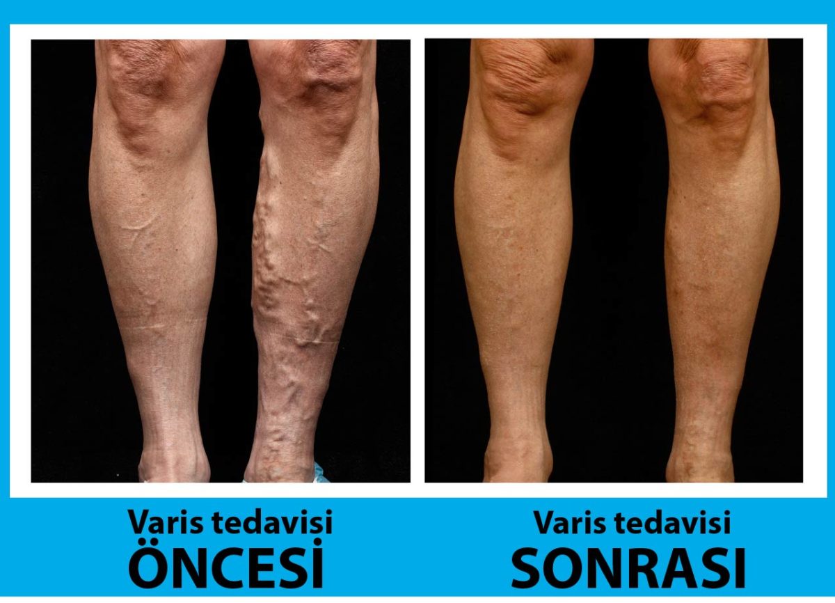 Varis Tedavisi