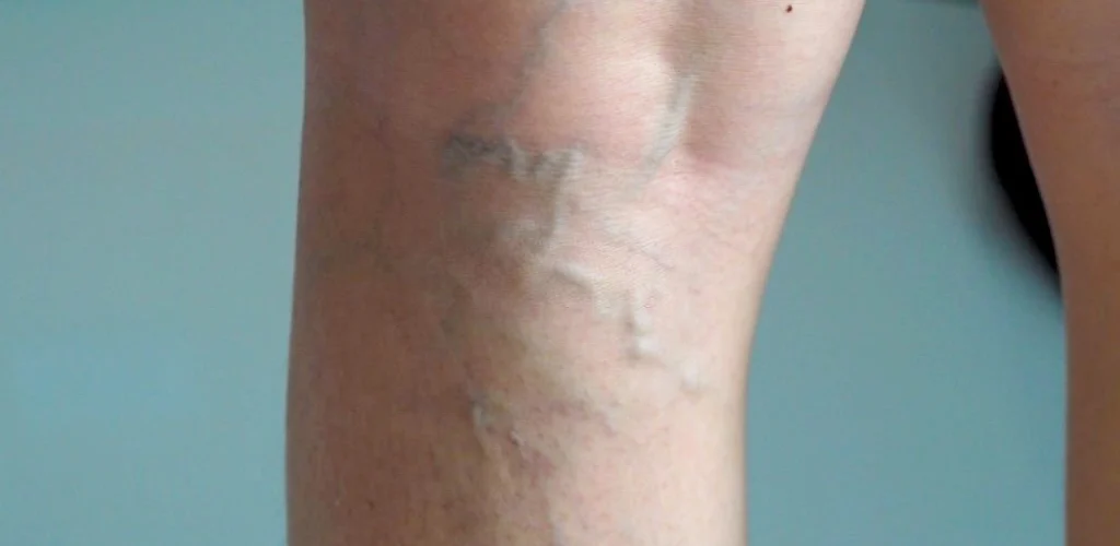 ilerlemis-varis-tedavisi