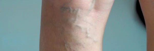 ilerlemis-varis-tedavisi