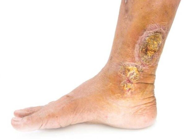 varis-yarasi-tedavisi