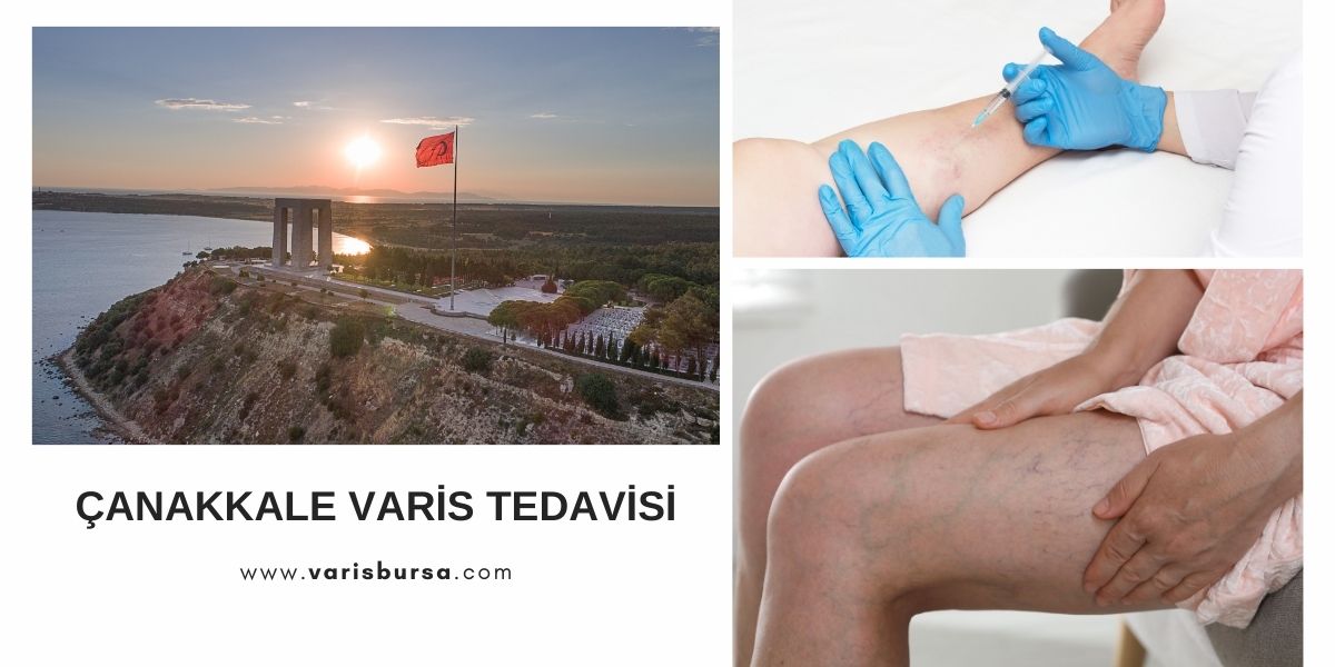 Varis Tedavisi