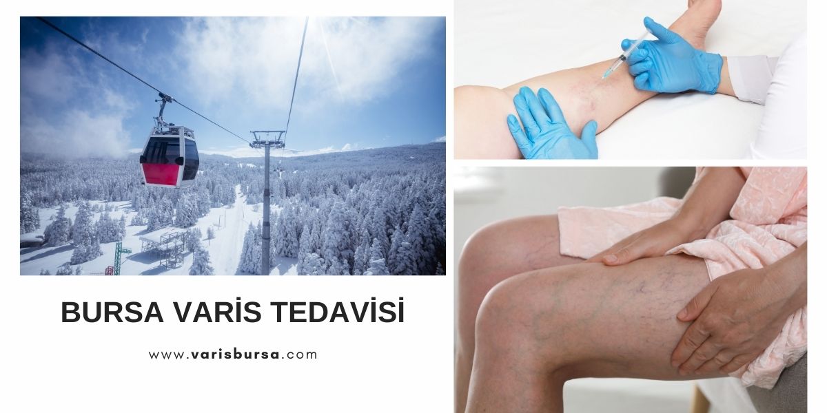 Varis Tedavisi