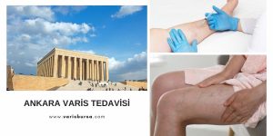 ankara varis tedavi