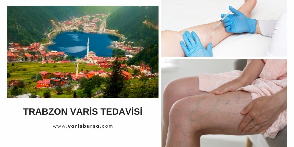 trabzon varis tedavi
